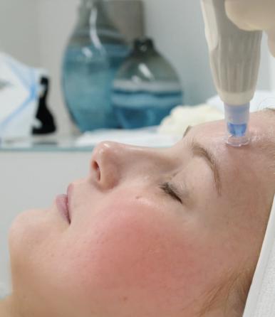 Hautprobleme lösen mit Needeling